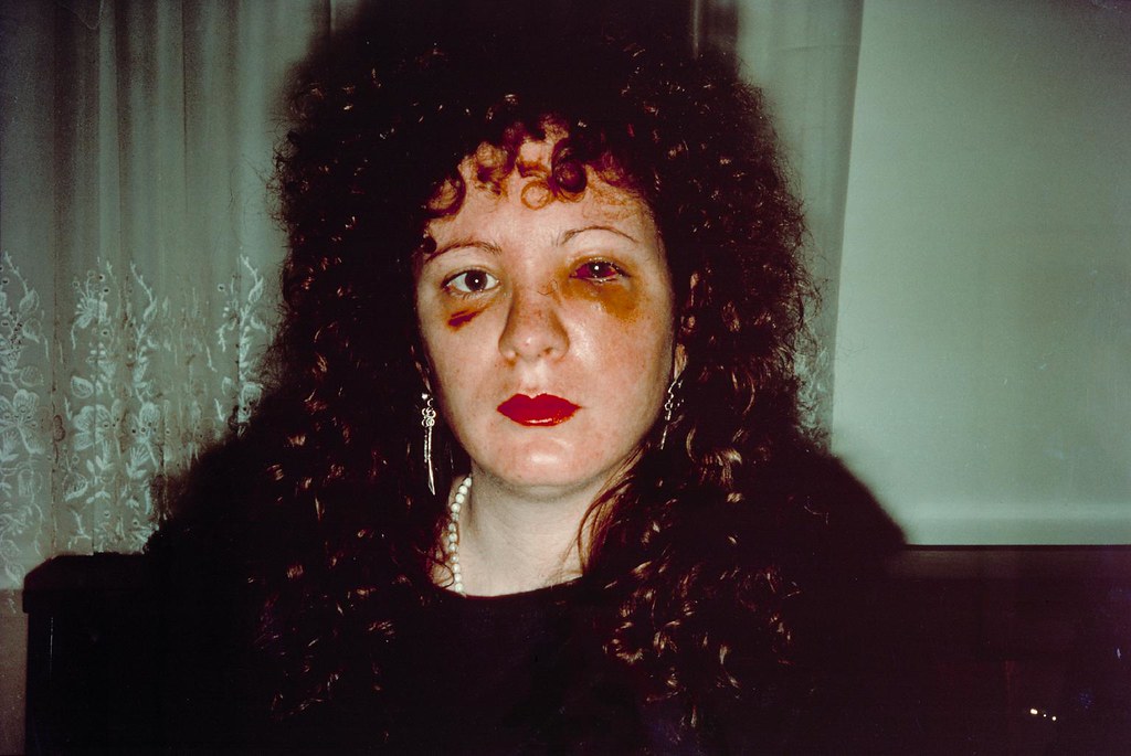 Nan one month after being battered, Nan Goldin, 1984